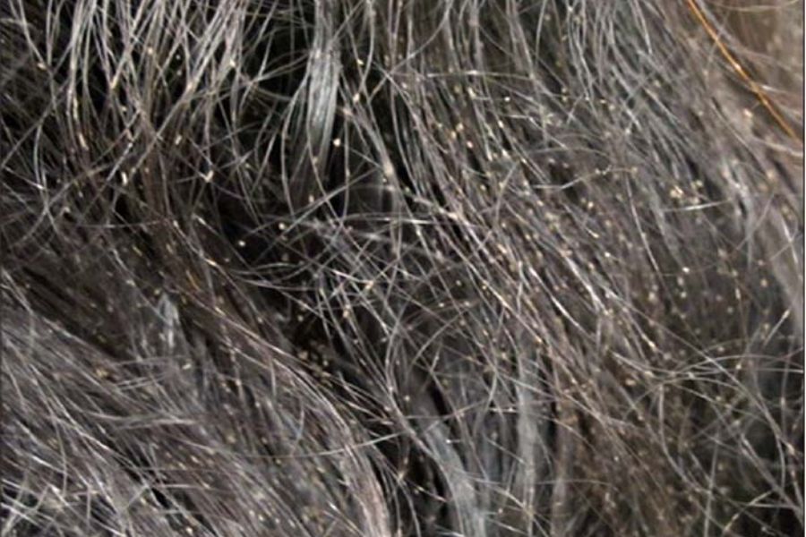 Como acabar com caruncho no cabelo?