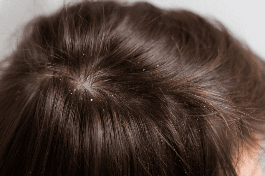 melhor shampoo para caspa feminino