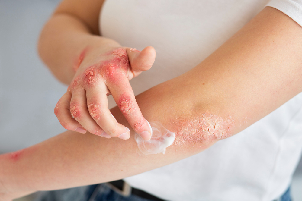Pele Ressecada no Inverno conheça Produtos Essenciais para Proteger e Nutrir seu Rosto